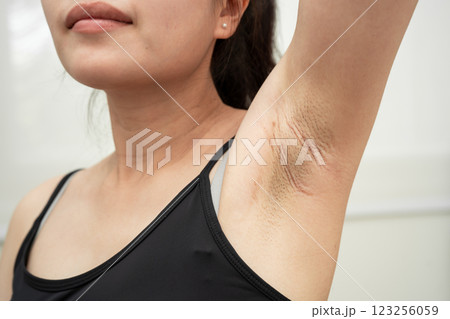 Asian woman have problem black armpit beauty skin care. 123256059