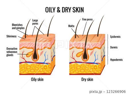 Oily and dry skin anatomy. Human body skin vector illustration with parts vein artery hair sweat gland epidermis dermis and hypodermis. Human Cross-section of the skin layers structure Oily and dry skin anatomy. Human body skin vector illustration with parts vein artery hair sweat gland epidermis dermis and hypodermis. Human Cross-section of the skin layers structure 123266906