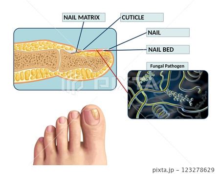 Toenail fungus infection Toenail fungus infection 123278629