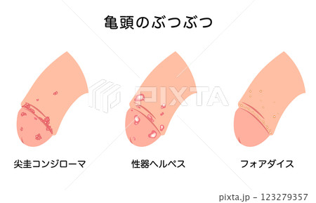 男性生殖器にできたぶつぶつ　性病の種類 123279357