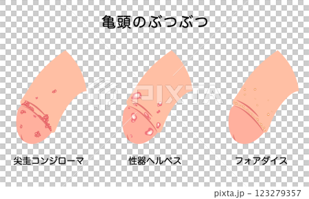 男性生殖器にできたぶつぶつ　性病の種類 123279357