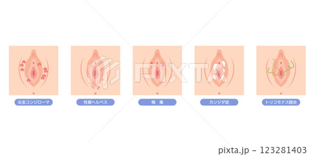 女性外性器の病気 女性外性器の病気 123281403