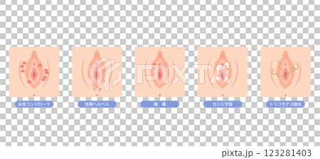 女性外生殖器疾病 123281403