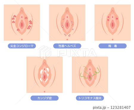 女性外性器の病気 123281407