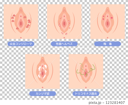 女性外性器の病気 123281407
