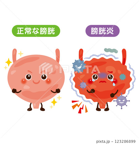 正常な膀胱と膀胱炎のキャラクターイラスト 123286899