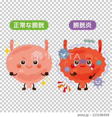 正常な膀胱と膀胱炎のキャラクターイラスト 123286899