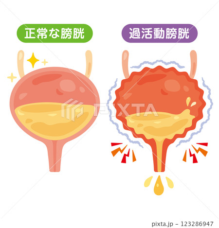 正常な膀胱と過活動膀胱のイラスト 正常な膀胱と過活動膀胱のイラスト 123286947