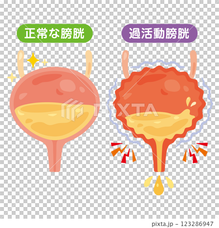 正常膀胱和過度活動性膀胱的圖示 正常膀胱和過度活動性膀胱的圖示 123286947
