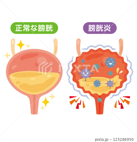 正常な膀胱と膀胱炎のイラスト 123286950