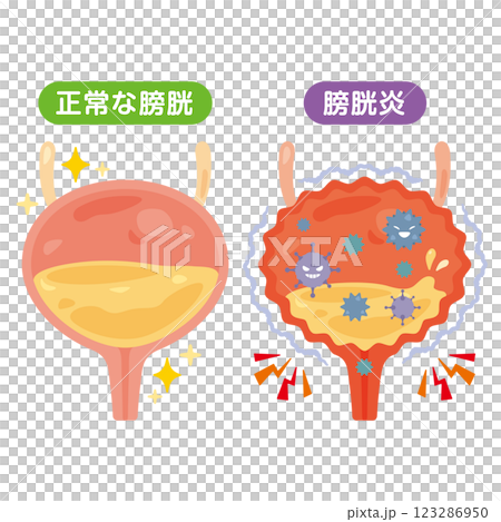 Illustration of a normal bladder and cystitis 123286950