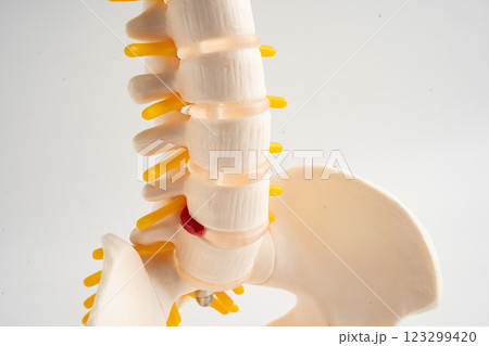 Lumbar spine displaced herniated disc fragment, spinal nerve and bone. Model for treatment medical in the orthopedic department. 123299420