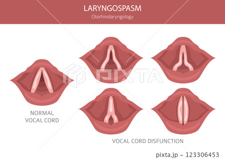 Laryngospasm diseases. Otorhinolaryngology. Vocal cord disfunction. Medical infographic design Laryngospasm diseases. Otorhinolaryngology. Vocal cord disfunction. Medical infographic design 123306453
