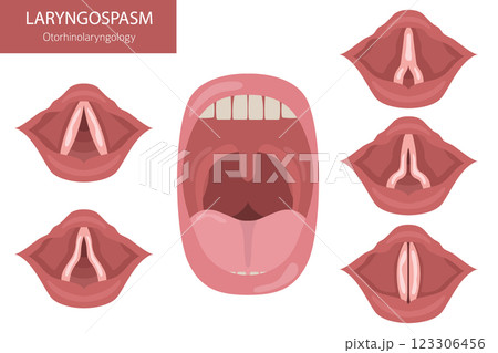 Laryngospasm diseases. Otorhinolaryngology. Vocal cord disfunction. Medical infographic design 123306456