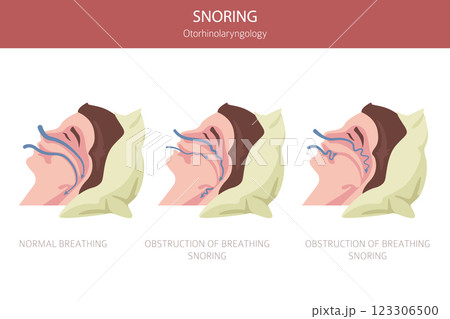 Snoring diseases. Obstructive sleep apnea. Sleep related breathing disorder. Medical infographic design Snoring diseases. Obstructive sleep apnea. Sleep related breathing disorder. Medical infographic design 123306500