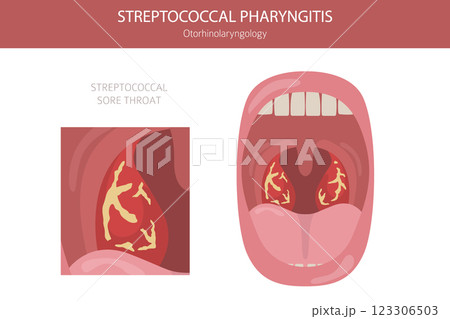 Tonsils and throat diseases. Streptococcal Pharyngitis. Medical infographic design 123306503