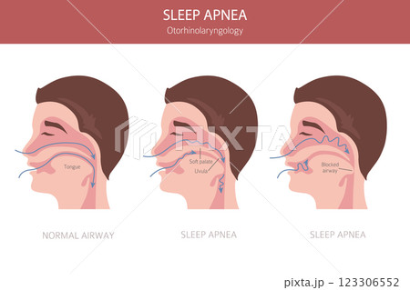 Sleep Apnea diseases. Otorhinolaryngology. Sleep related breathing disorder. Medical infographic design Sleep Apnea diseases. Otorhinolaryngology. Sleep related breathing disorder. Medical infographic design 123306552
