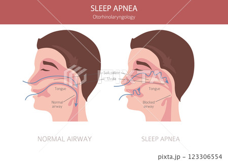 Sleep Apnea diseases. Otorhinolaryngology. Sleep related breathing disorder. Medical infographic design 123306554