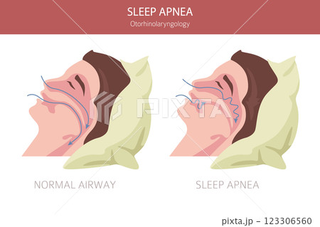 Sleep Apnea diseases. Otorhinolaryngology. Sleep related breathing disorder. Medical infographic design Sleep Apnea diseases. Otorhinolaryngology. Sleep related breathing disorder. Medical infographic design 123306560