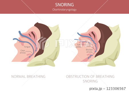 Snoring diseases. Obstructive sleep apnea. Sleep related breathing disorder. Medical infographic design Snoring diseases. Obstructive sleep apnea. Sleep related breathing disorder. Medical infographic design 123306567