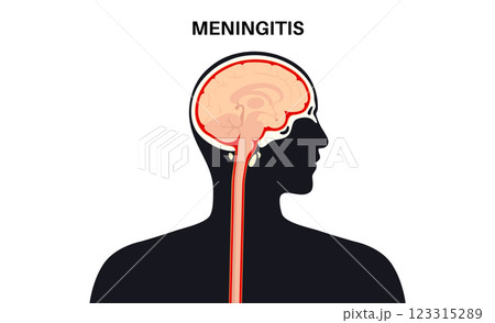 Meningitis medical poster 123315289