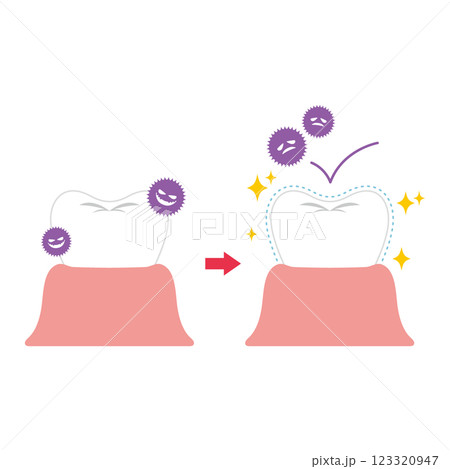 色素沈着や虫歯予防のコーティングをした歯のイラスト 123320947