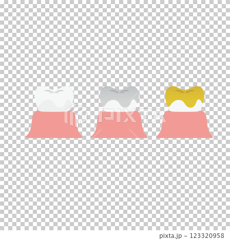 歯の各種かぶせ物のイラスト 123320958