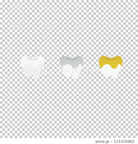歯の各種かぶせ物のイラスト 歯の各種かぶせ物のイラスト 123320962