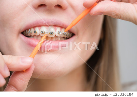 Unrecognizable Caucasian woman cleans braces with a brush. Close-up of female teeth with brackets 123336194