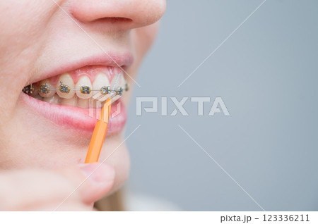 Unrecognizable Caucasian woman cleans braces with a brush. Close-up of female teeth with brackets 123336211
