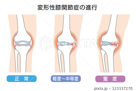 変形性膝関節症の進行を表したイラスト 123337270