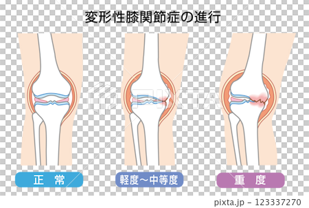 変形性膝関節症の進行を表したイラスト 123337270