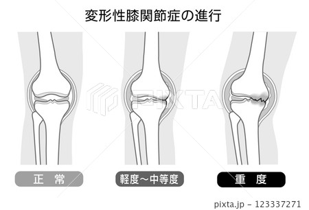 変形性膝関節症の進行を表したモノトーンのイラスト 123337271