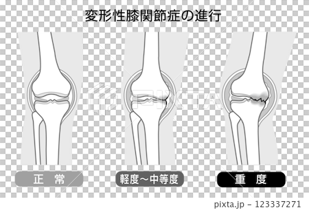 Monotone illustration showing the progression of knee osteoarthritis 123337271