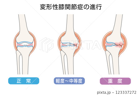 変形性膝関節症の進行を表したイラスト 変形性膝関節症の進行を表したイラスト 123337272