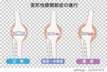 変形性膝関節症の進行を表したイラスト 変形性膝関節症の進行を表したイラスト 123337272