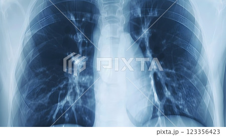 Chest X-ray Representation Showing Pneumonia with a Clear Contrast Between Healthy Lung Tissue and Areas Affected by Infection 123356423
