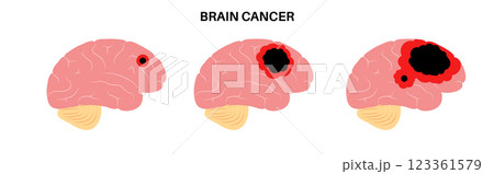 Brain cancer grade 123361579