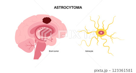 Astrocytoma brain cancer Astrocytoma brain cancer 123361581