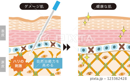 美容鍼の施術における肌への作用と効果のビフォーアフター 123362428