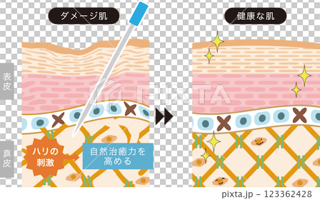 美容鍼の施術における肌への作用と効果のビフォーアフター 123362428