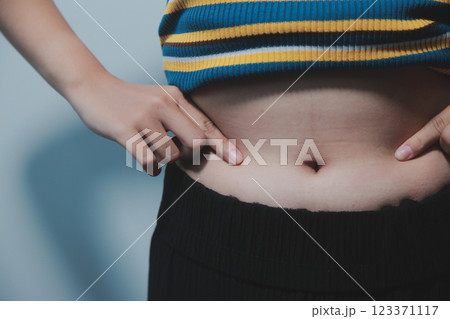 Women body fat belly. Obese woman hand holding excessive belly fat. diet lifestyle concept to reduce belly and shape up healthy stomach muscle. 123371117