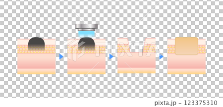 Vector illustration of cross section of skin being irradiated with laser Vector illustration of cross section of skin being irradiated with laser 123375310