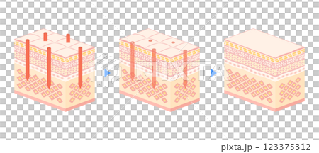 Vector illustration of cross section of skin being irradiated with laser Vector illustration of cross section of skin being irradiated with laser 123375312