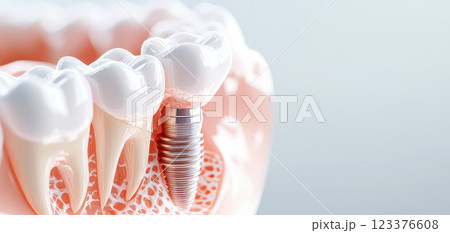 Dental implant cross section showing placement in jawbone structure Dental implant cross section showing placement in jawbone structure 123376608