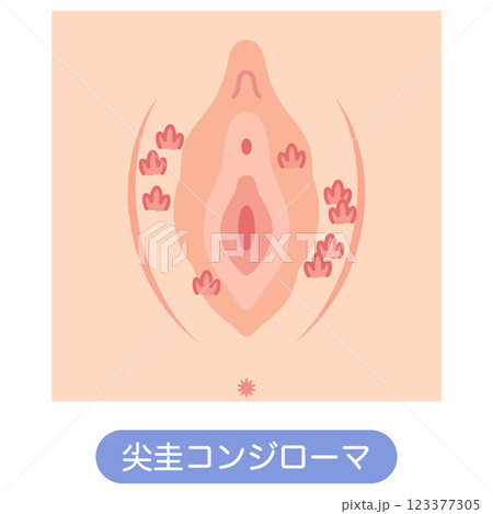 女性外性器の病気　尖圭コンジローマ 123377305