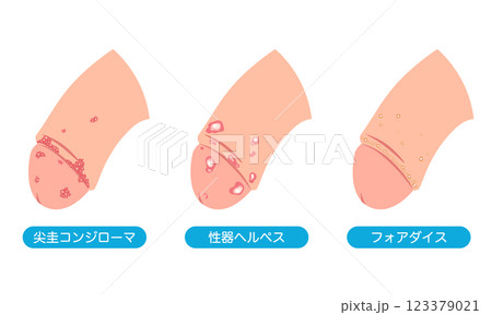 男性生殖器にできたぶつぶつ　性病の種類 123379021