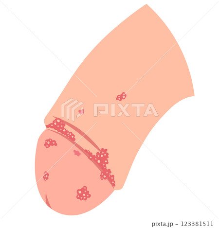 尖圭コンジローマ 男性生殖器にできたぶつぶつ 尖圭コンジローマ 男性生殖器にできたぶつぶつ 123381511