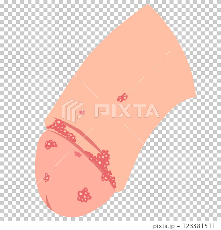 尖圭コンジローマ 男性生殖器にできたぶつぶつ 尖圭コンジローマ 男性生殖器にできたぶつぶつ 123381511