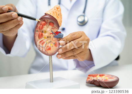 Chronic kidney disease, doctor with model for treatment urinary system, urology, Estimated glomerular filtration rate eGFR. 123390536